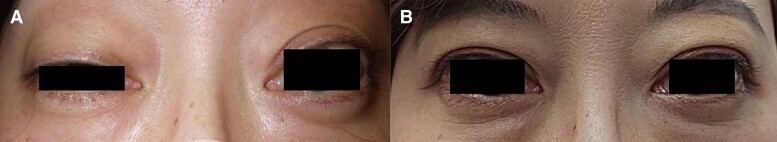 Concomitant Exacerbation of Graves Orbitopathy and Double-Seronegative Myasthenia Gravis after SARS-CoV-2 Infection.