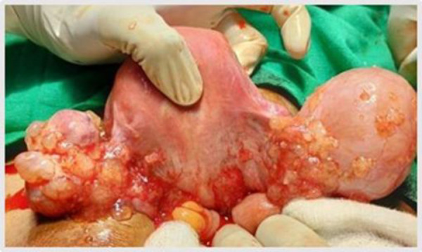 Low Grade Appendiceal Mucinous Neoplasm - A Case Series A Silent Threat with Deadly Consequences.