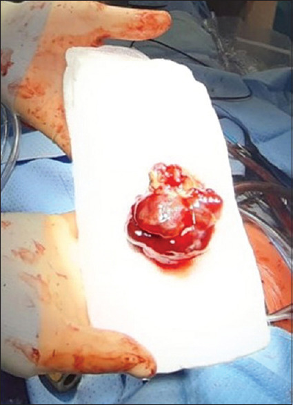 Right Ventricular Myxoma Presenting in a Patient With Known Arteriovenous Malformations in the Brain: A Case Report.