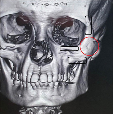 A modified high infraorbital with lateral crow feet extension incision (Punincision) for body of zygoma fractures and zygoma implants: Original research.