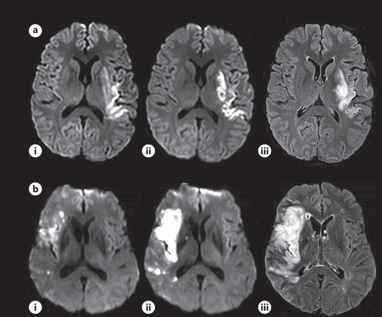 Late Lesion Growth following Endovascular Therapy: Is 24 h Too Early to Assess Acute Infarct Size Including the Effects of Secondary Injury?