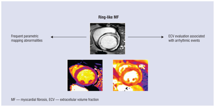 Shaping cardiac diagnostics: The role of myocardial tissue mapping in unraveling ring-like fibrosis.