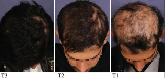 Randomized Controlled Trial Study to Evaluate the Efficacy of Combination Therapy with Diphenylcyclopropenone and Platelet-Rich Plasmain Alopecia Areaata.