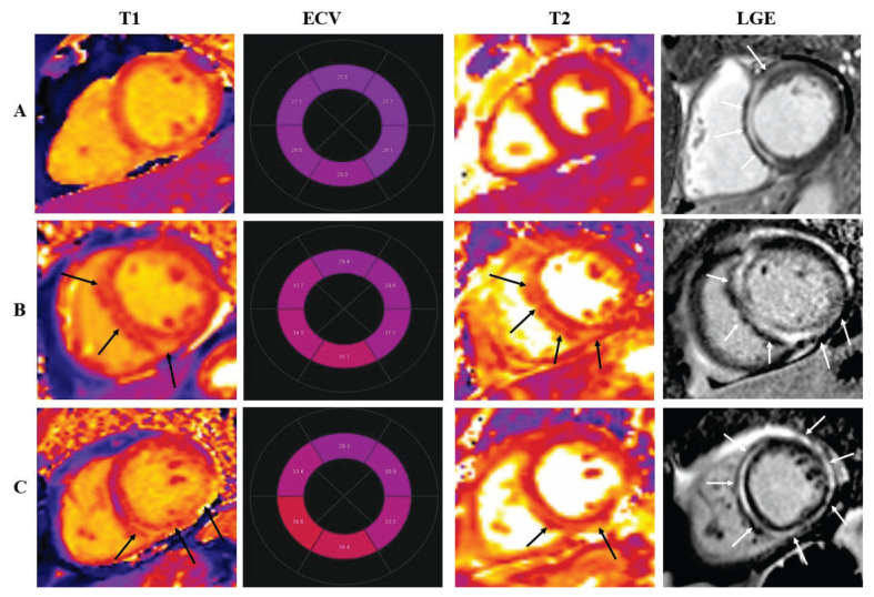 Shaping cardiac diagnostics: The role of myocardial tissue mapping in unraveling ring-like fibrosis.