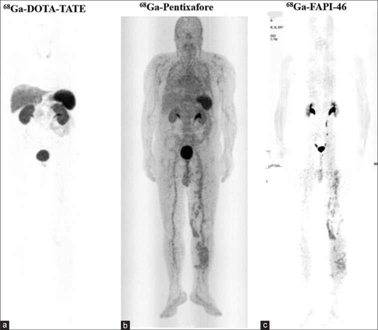 Fibroblast Activation Protein (FAP): A Crucial Modulator of the Microenvironment in Metastatic Melanoma Case.