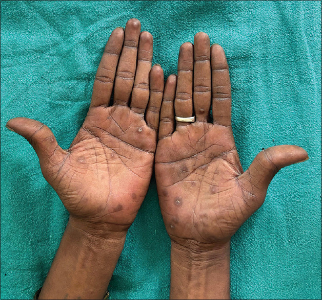 Coexisting chancre and features of secondary syphilis in an immunocompetent male.