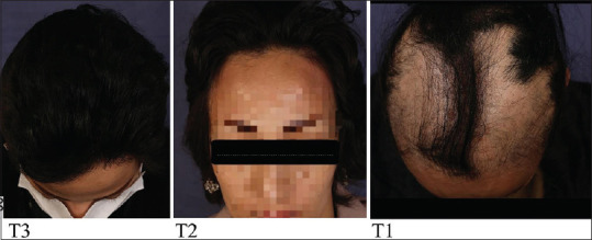 Randomized Controlled Trial Study to Evaluate the Efficacy of Combination Therapy with Diphenylcyclopropenone and Platelet-Rich Plasmain Alopecia Areaata.
