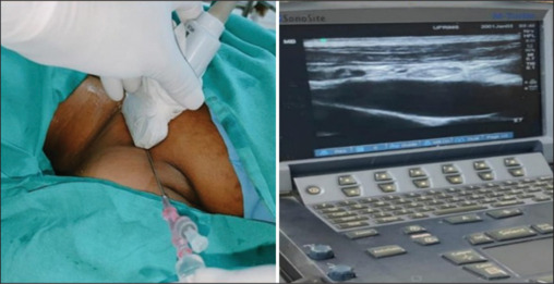 Comparison of safety and efficacy of ultrasound-guided supraclavicular and infraclavicular subclavian vein cannulation in intensive care unit patients: A randomized clinical study.