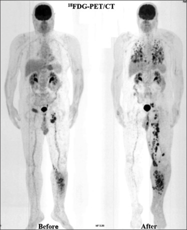 Fibroblast Activation Protein (FAP): A Crucial Modulator of the Microenvironment in Metastatic Melanoma Case.