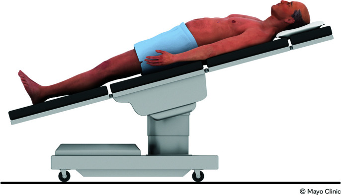 Robotic Common Bile Duct Exploration for Choledocholithiasis.
