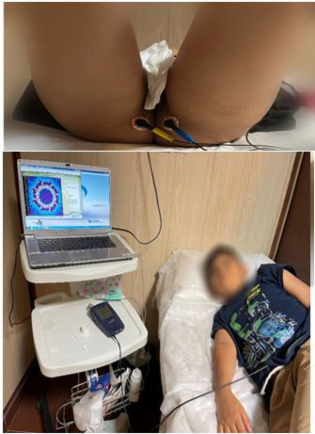 Investigating the effects of using Tecar therapy with biofeedback compared to biofeedback alone in the treatment of fecal incontinence in children aged 4 to 16 years: a randomized clinical trial study.