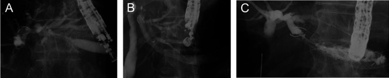 Impact of self-expandable metal stent deployment site on stent dysfunction during EUS-guided hepaticogastrostomy.