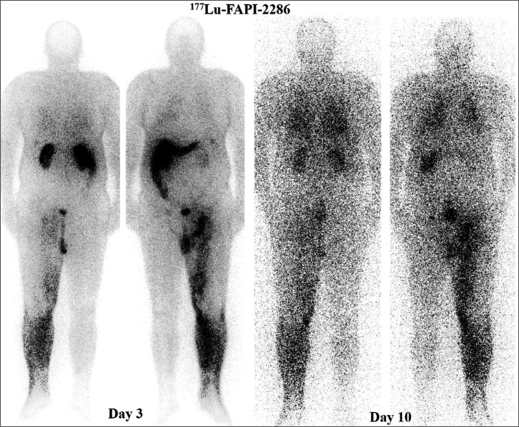 Fibroblast Activation Protein (FAP): A Crucial Modulator of the Microenvironment in Metastatic Melanoma Case.