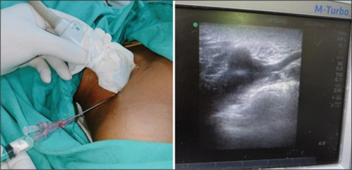 Comparison of safety and efficacy of ultrasound-guided supraclavicular and infraclavicular subclavian vein cannulation in intensive care unit patients: A randomized clinical study.