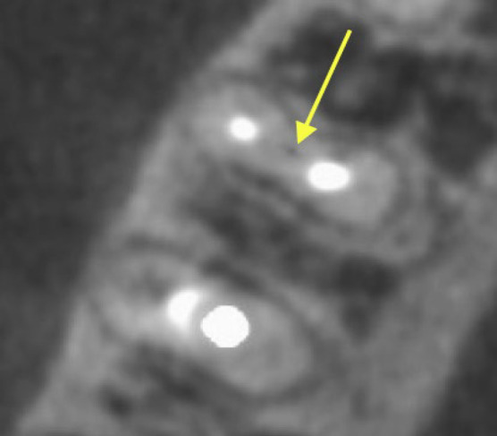 Correlation between the Middle Mesial Canal and Furcation Radiolucency in Mandibular Molars.