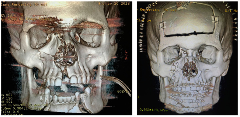 A Shift in Conceptual Thinking of Panfacial Fracture Sequencing: The Major Fragment Theory.