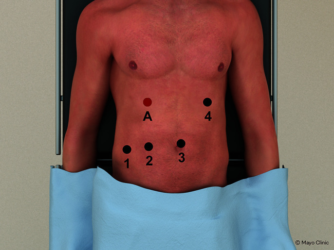 Robotic Common Bile Duct Exploration for Choledocholithiasis.
