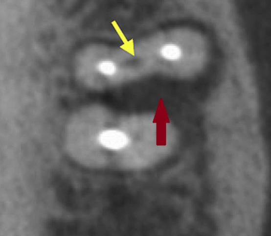 Correlation between the Middle Mesial Canal and Furcation Radiolucency in Mandibular Molars.