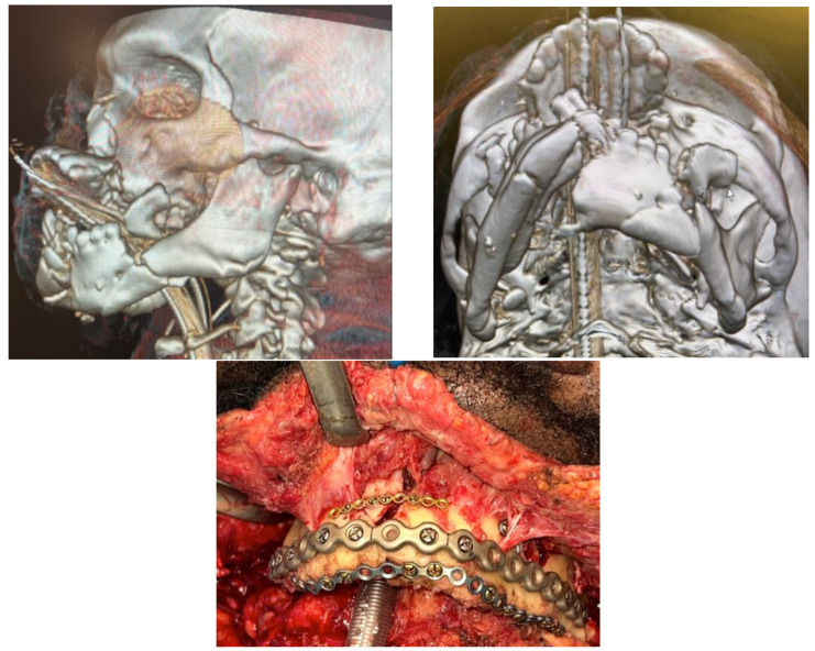 A Shift in Conceptual Thinking of Panfacial Fracture Sequencing: The Major Fragment Theory.