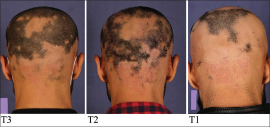 Randomized Controlled Trial Study to Evaluate the Efficacy of Combination Therapy with Diphenylcyclopropenone and Platelet-Rich Plasmain Alopecia Areaata.