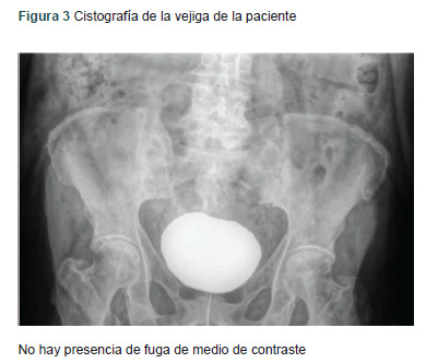[Tenckhoff catheter placed in bladder. Case and review].