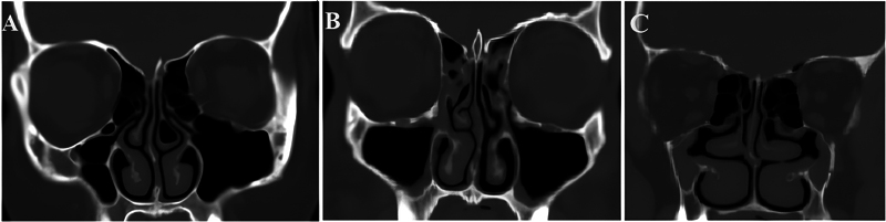 Description of the Uncinate Process: A Computed Tomography Cross-Sectional Study.