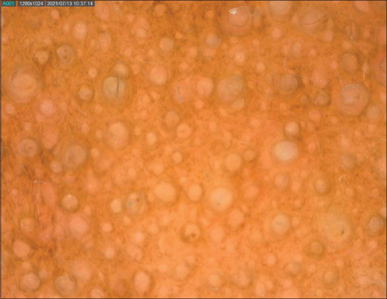 Unilateral Follicular Facial Papules in a Child.