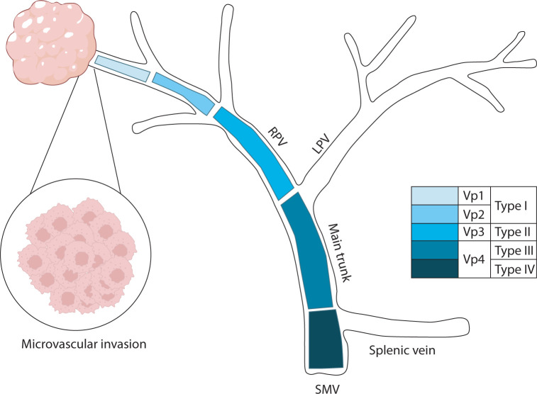 Management strategies for advanced hepatocellular carcinoma with portal vein tumor thrombosis.