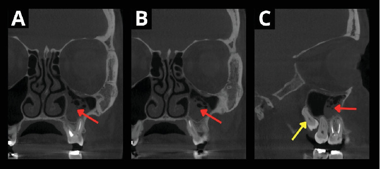 Revascularization of an Autotransplanted Mature Tooth After Extraoral Root Resection: A Case Report.