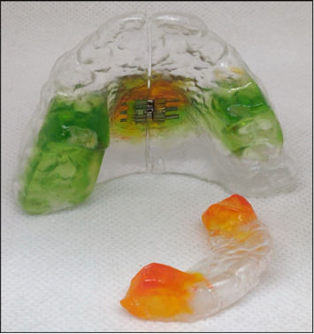 Efficiency of Polyethylene Terephthalate Glycol Thermoplastic Material to Functional and Expansion Forces in Orthodontic Applications: An Experimental Study.