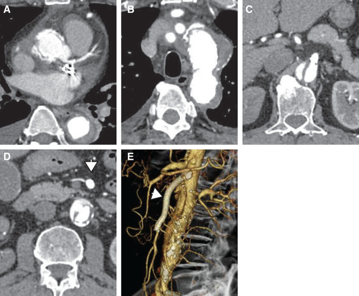 Successful Emergency Stenting of a Visceral Branch Prior to Central Aortic Repair in Type A Aortic Dissection with Mesenteric Malperfusion: A Case Report.