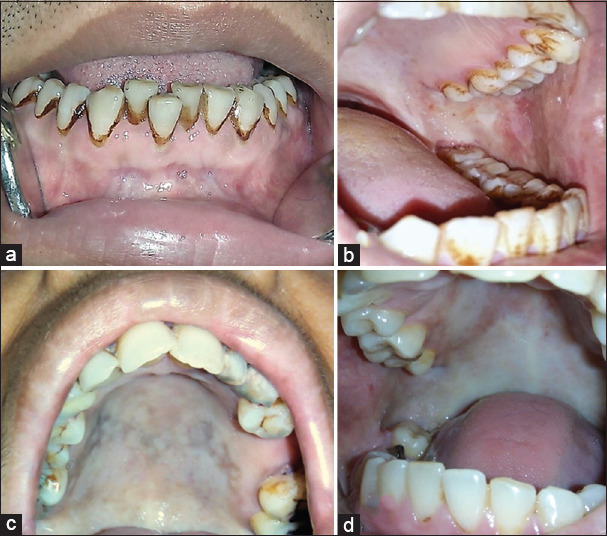 Correlation of blanching, fibrosis, and uvular changes with the extent of mouth opening in oral submucous fibrosis - A 9-year retrospective analysis.