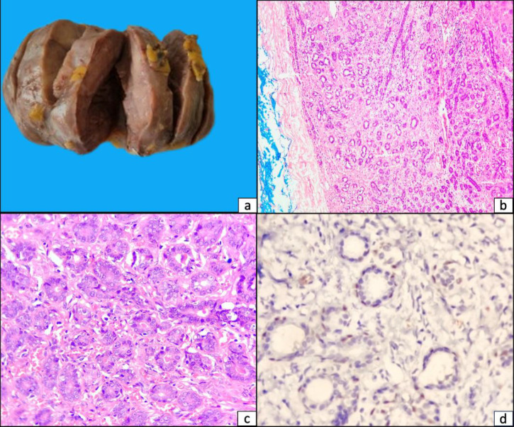 Giant Tubular Adenoma of the Breast in an Adolescent: Diagnostic Challenges and Literature Review.