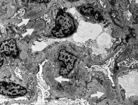 A Case of IgA Nephropathy in a Patient With Sarcoidosis: Confirmation of Glomerular Galactose-Deficient IgA1 Deposition.