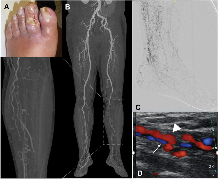 Combined Arterial Reconstruction and Surgical Distal Venous Arterialization for Limb Salvage in Thromboangiitis Obliterans: A Case Report.