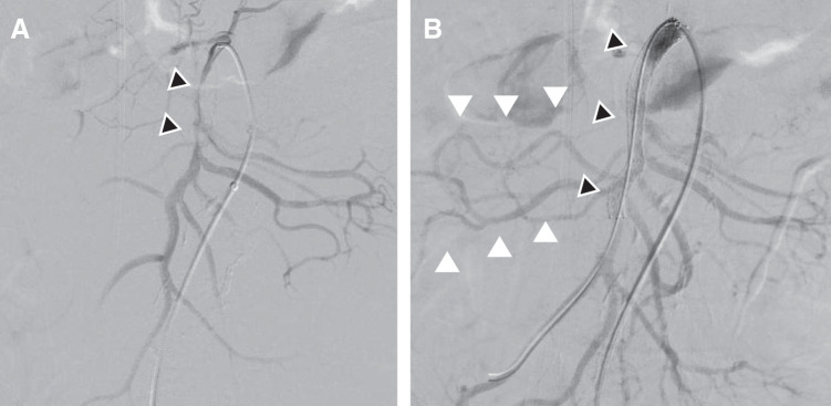 Successful Emergency Stenting of a Visceral Branch Prior to Central Aortic Repair in Type A Aortic Dissection with Mesenteric Malperfusion: A Case Report.