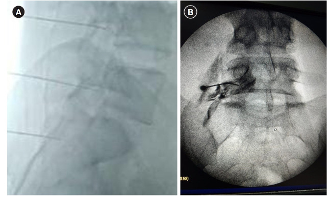 Dexmedetomidine versus hyaluronidase along with lumbar transforaminal epidural steroid injection in failed back surgery: a randomized double-blind clinical trial.