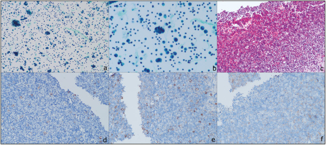 The Role of Immunohistochemistry in Reducing the "Atypia of Undetermined Significance (AUS)" Category in Serous Fluid Cytology.