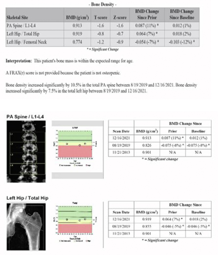 Hypogonadism in a Man With Cystic Fibrosis and an Unusually Low Serum Testosterone: A Cautionary Tale