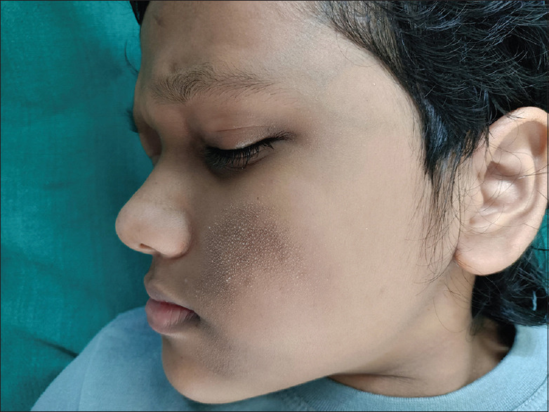 Unilateral Follicular Facial Papules in a Child.