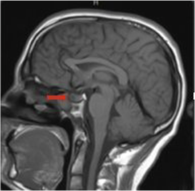 Hypogonadism in a Man With Cystic Fibrosis and an Unusually Low Serum Testosterone: A Cautionary Tale