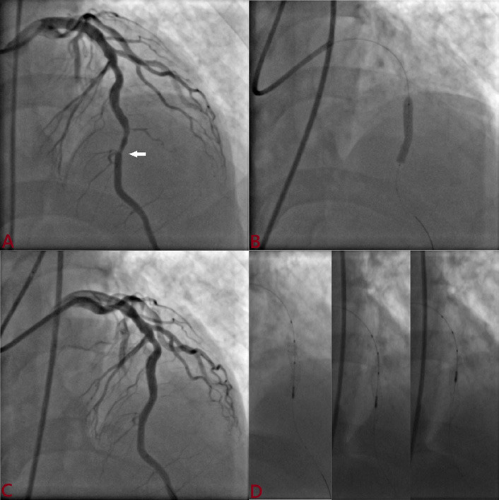 Evaluation of novel ultrathin, biodegradable polymer tetriflex (sirolimus-eluting stent) optimization using intravascular ultrasound (IVUS) in short coronary lesion (≤ 20mm) vs. long coronary lesion (≥ 20mm): Tetriflex IVUS study.