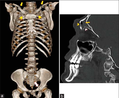 Bilateral First Rib Fractures in Blunt Trauma Patients: A Retrospective Study.
