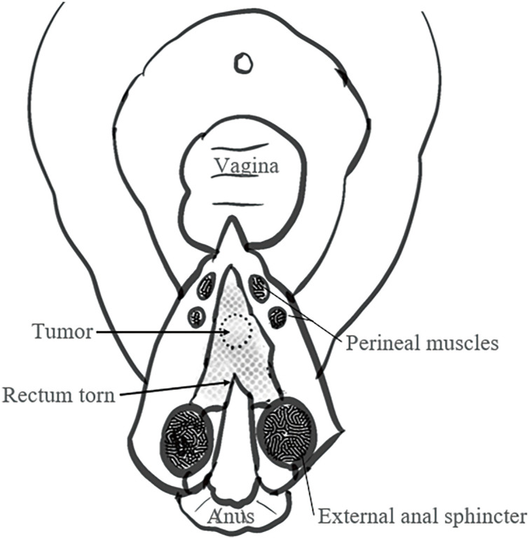 Robot-Assisted Ultra-Low Anterior Resection for Rectal Neuroendocrine Tumors after Severe Perineal Tears: A Case Report.