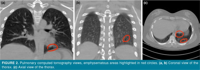 To perform or not to perform fasciotomy? A rare case report.