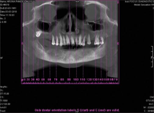 Bone mineral density as a criterion for primary implant stability: A retrospective CBCT analysis.