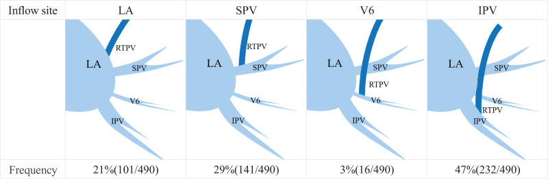 Impact of Right Top Pulmonary Vein Location on Subcarinal Lymph Node Dissection in Thoracoscopic Esophagectomy: A Case Report and Literature Review.