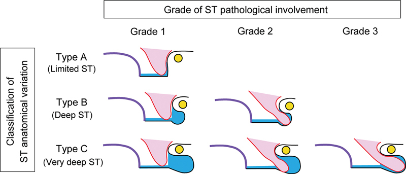 Postoperative Hearing Outcomes and Usefulness of Endoscopy-Assisted Tympanoplasty in Pars Tensa Cholesteatoma.