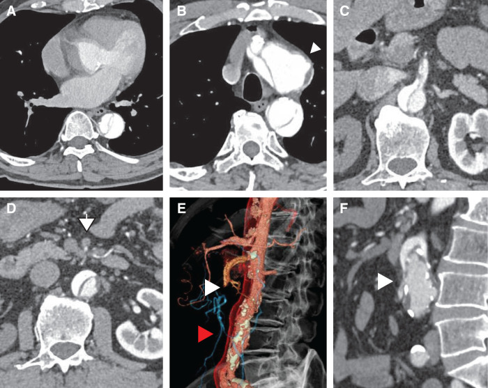 Successful Emergency Stenting of a Visceral Branch Prior to Central Aortic Repair in Type A Aortic Dissection with Mesenteric Malperfusion: A Case Report.
