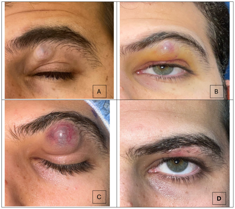 Case report: Periorbital pilomatricoma: a rare benign skin tumor misdiagnosed as cellulitis.